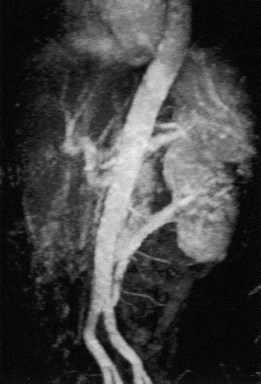 Mr Angiographic Diagnosis Of An Aberrant Retroaortic Left Renal Vein