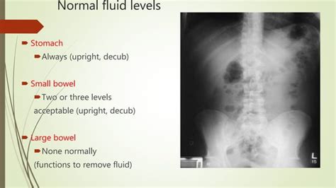 Abdominal X Ray Interpretation Ppt Ppt