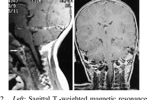 Figure From Tumoral Calcinosis Of The Cervical Spine In An Infant