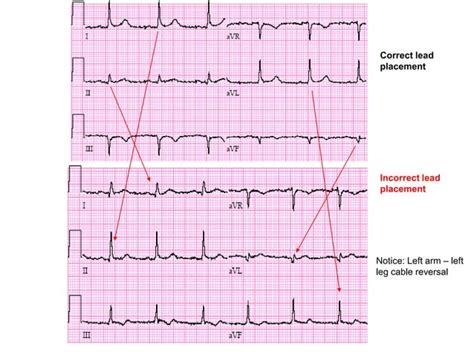 Reversal Limb Leads Ppt