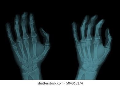 287 Middle Finger Xray Images Stock Photos 3D Objects Vectors