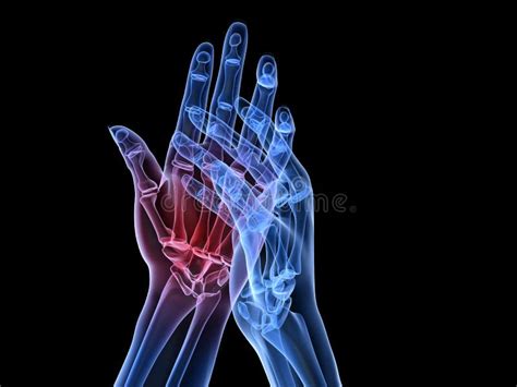 X-ray hands - arthritis stock illustration. Illustration of hand - 12694973