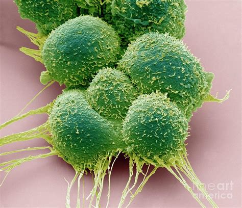 Prostate Cancer Cells By Science Photo Library