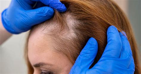 When Hair Loss Chemotherapy Is Appropriate