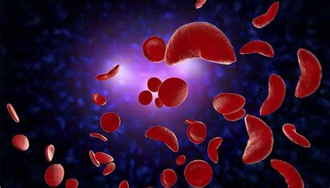 Sickle Cell Disease Medtour