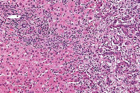 Cholangiocarcinoma Libre Pathology