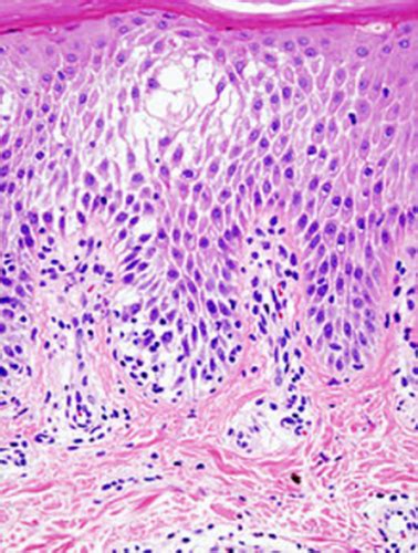 Papulosquamous And Eczematous Dermatoses Flashcards Quizlet