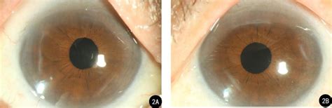 Right And Left Postoperative Anterior Segment Photography From Case 1 Download Scientific