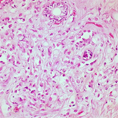 Signet Ring Cell Carcinoma Signet Ring