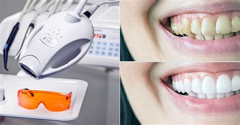 Отбеливание ZOOM 4: Ваша улыбка в новом цвете — Teletype