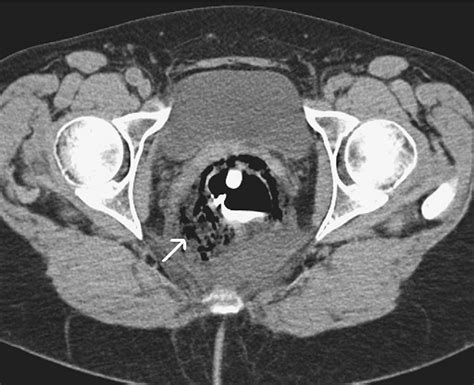 Rectal Perforation Caused By Retroflexion Maneuver During Colonoscopy Closure With Endoscopic