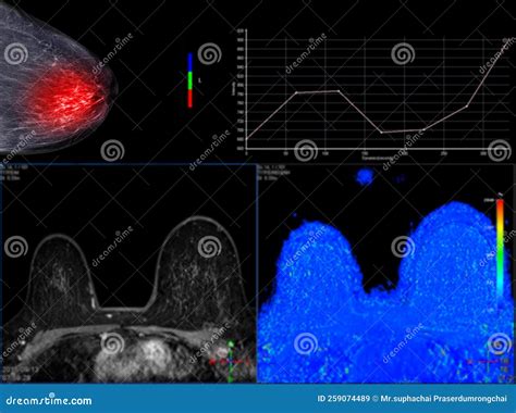 Espectroscopia De Resonancia Magn Tica De La Mama Imagen De Archivo