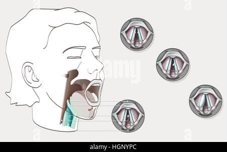 Vocal Cord Nodules Stock Photo - Alamy