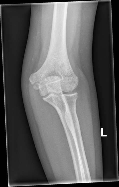 Supracondylar Fracture Adult Image