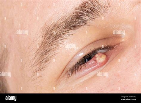 Eye Of A Guy With Stye Close Up Acute Red Purulent Inflammation Of The