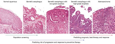 biomarkers  barretts esophagus  esophageal adenocarcinoma