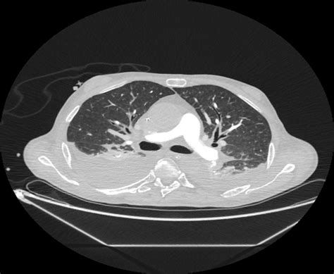 Postcontrast Thoracic CT Scan Revealing Bilateral Pleural Effusions No