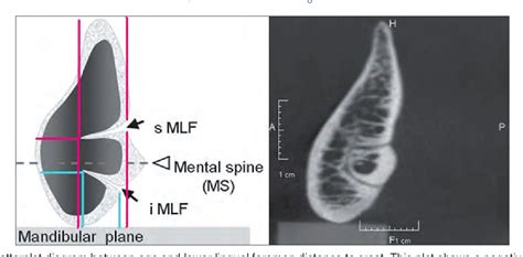 Lingual foramen | Semantic Scholar