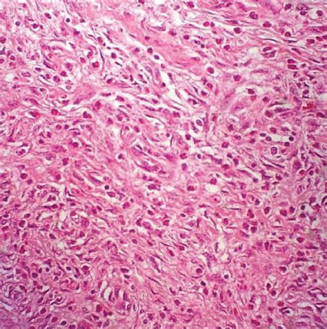 A Histological Examination Of The Inflammatory Fibroid Polyp In The