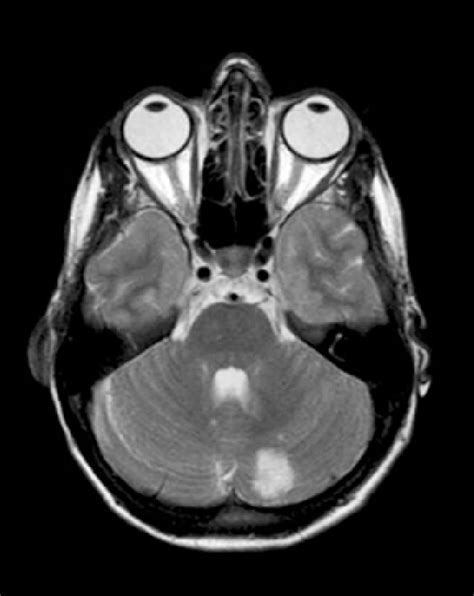 Brain MRI: infarction around the left cerebellar artery. | Download Scientific Diagram