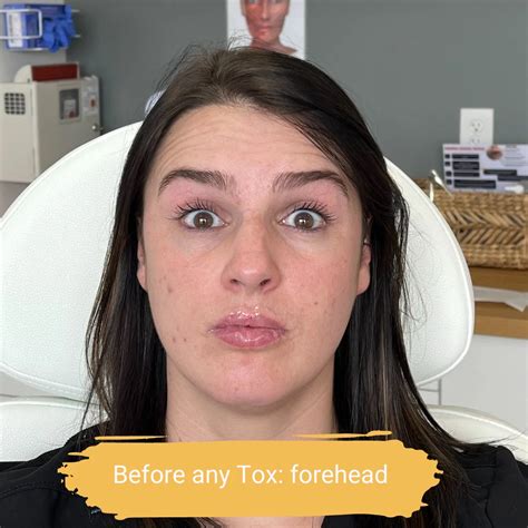 How Botox Kicks In Elite Medical And Aesthetics Lone Tree Co 80124