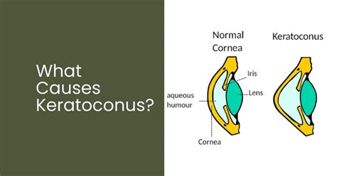 What Causes Keratoconus Boneham Optometrist