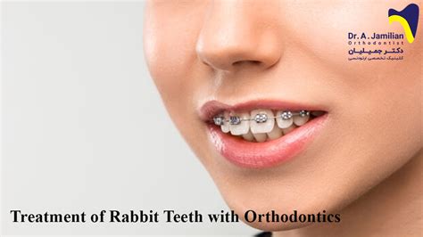 Treatment of rabbit teeth with orthodontics - Dr Jamilian