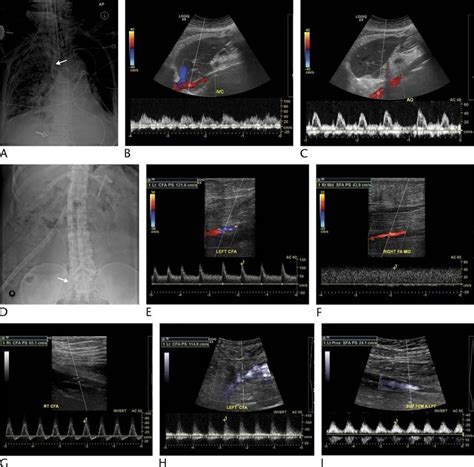 Doppler Flow Patterns And Complications Of Ecmo A To C Venous Venous