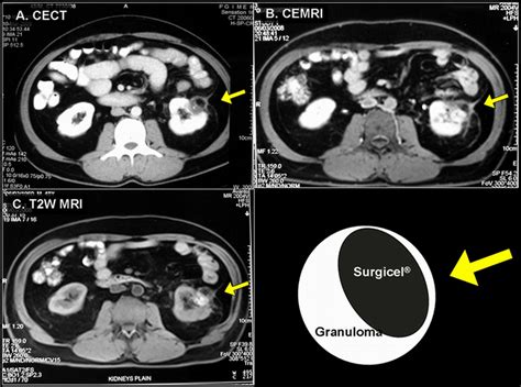 Surgicel Granuloma Unusual Cause Of “recurrent” Mass Lesion After Laparoscopic Nephron Sparing