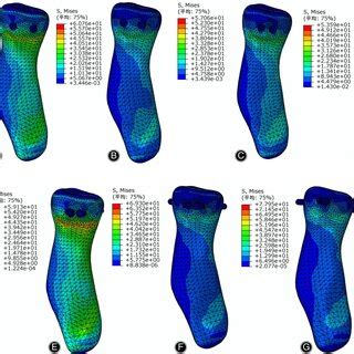 The Common Characteristics Of The Mason Type Ii Radial Head Fractures