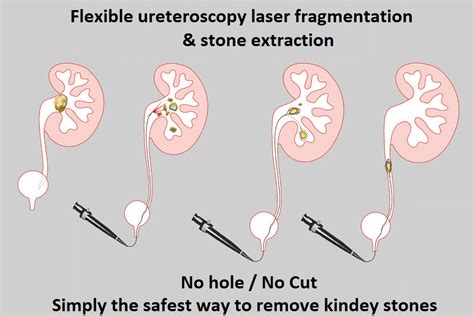 Chirurgie Des Calculs Rénaux Advanced Medical Robotic Surgery