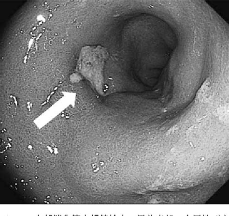 Figure 1 From Hemophagocytic Syndrome Recurring Shortly After Gastric