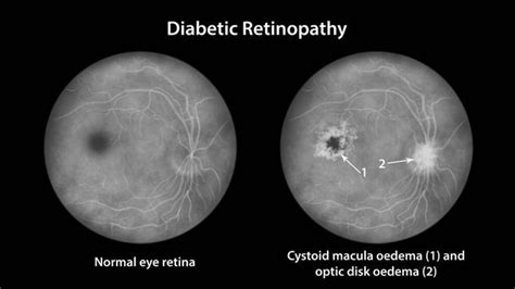 Macula edema Free Stock Photos, Images, and Pictures of Macula edema