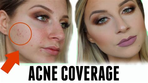 How To Correct And Conceal Acne Scar Coverage Youtube