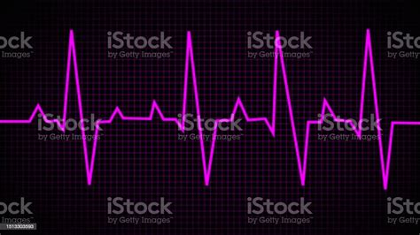 Coronary Artery Disease Electrocardiogram Show St Elevation Myocardial