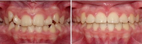 Moderate Crowding Teeth