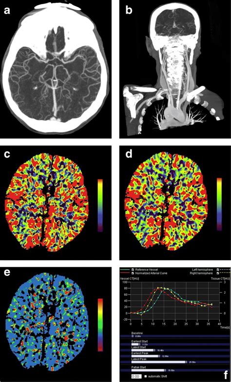 Cta And Ctp Via Io Access A Maximum Intensity Projection Mip Axial