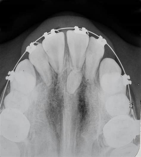 Hyperdontia, When You Have Extra Teeth - Class Dent