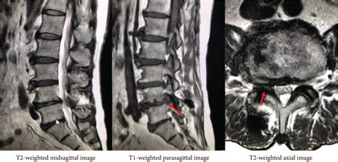 Mr Images Revealed Right L4 5 Foraminal Herniated Disc Without Fragment Download Scientific