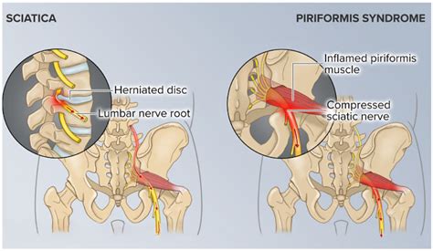 Understanding Piriformis Syndrome Vs Sciatica And The Role Of Remedial