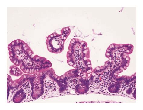 Photomicrograph Of Histopathology With Hande Stain Of Biopsy Specimen