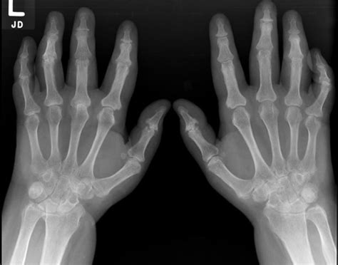 Psoriatic Arthritis Wikidoc