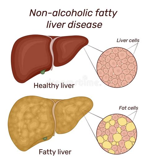 Nonalcoholic Fatty Liver Disease Stock Illustrations Nonalcoholic