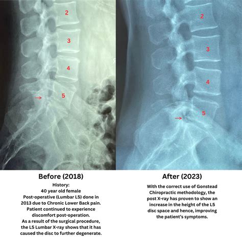 L5 Lumbar Disc Regeneration A Chiropractic Clinic Utilizes Gonstead Method