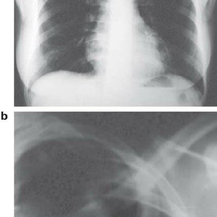 Posterior Anterior Chest Radiography Demonstrating Pulmonary