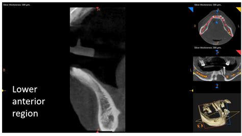 Combined tooth and implant-supported overdenture?