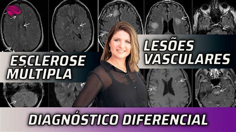 Diagn Stico Diferencial Entre Esclerose M Ltipla E Les Es Vasculares