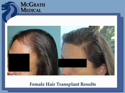 Before & After Female Patients - Houston Hair Restoration