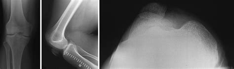 Radiological Characteristics Of The Knee Joint In Nail Patella Syndrome