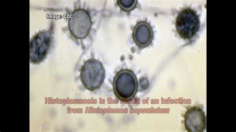 Histoplasma capsulatum & Histoplasmosis - YouTube